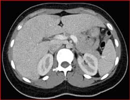 CT of the abdomen with oral and intravenous contrast