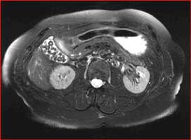 Abdominal MRI with numerous gallstones