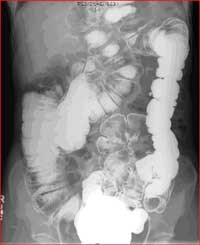 Double Contrast Barium Enema