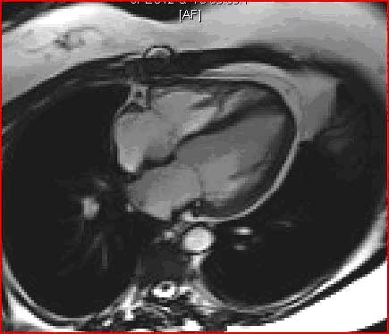 Normal Cardiac MRI