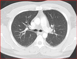 Normal Chest CT Scan