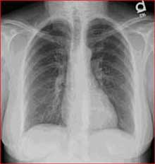 Normal Chest Xray