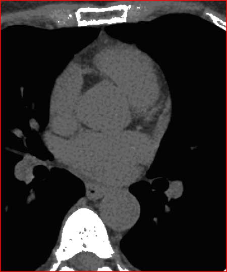 Normal Coronary Vessels