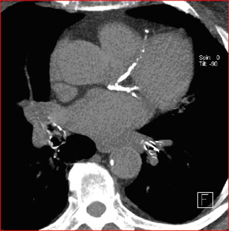 Heavily calcified coronary vessels with a score over 2000