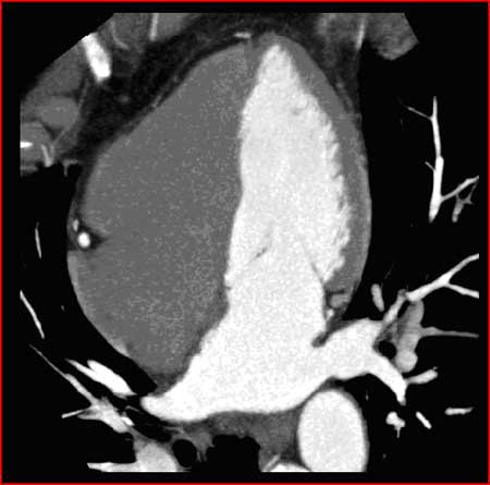 Dye is filling the left ventricle during cardiac CTA