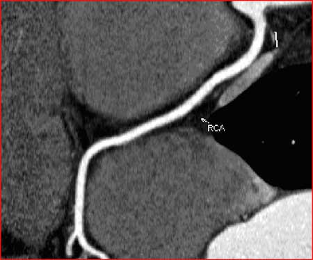 Normal Right Coronary Artery