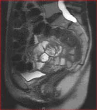 Sagital image of the pelvis during MRI defecography