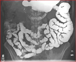 Small Bowel Follow-Through