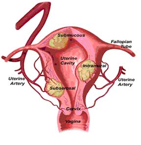 Uterine Fibroids