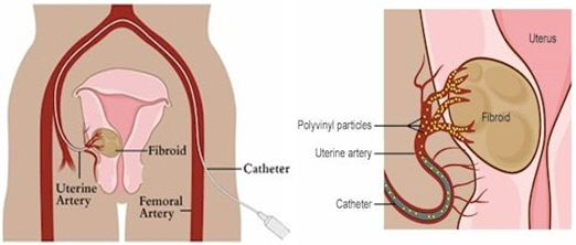 Uterine Fibroid Embolization (UFE)