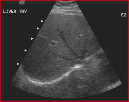 Ultrasound of the liver