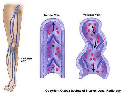 Varicose Veins