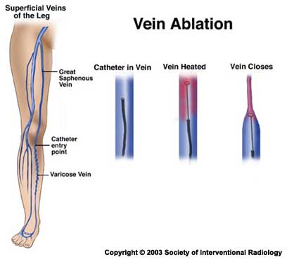 Varicose Veins