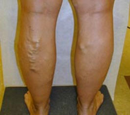 Varicose Veins