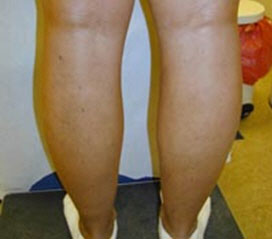 Varicose Veins